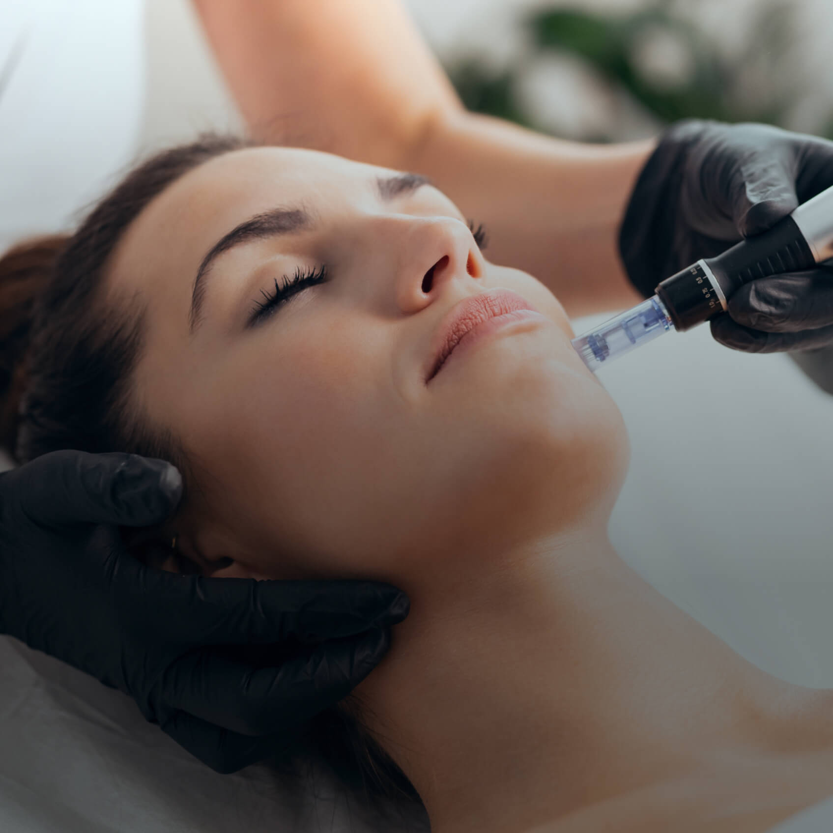 Microneedling